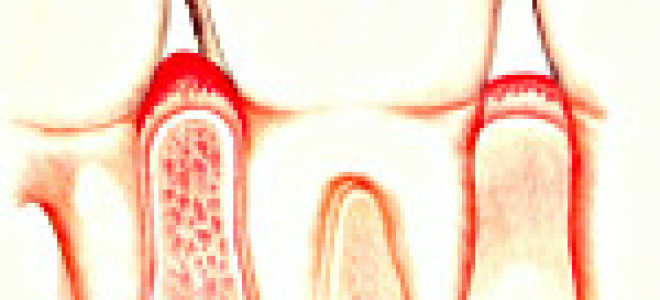 Красная зубная щетка? Симптомы и лечение острого гингивита у детей и взрослых. Гингивит. Острый гингивит Сильный гингивит