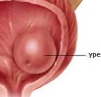 Киста в мочеточнике у женщин симптомы. Уретероцеле: что это такое, причины и операция. Единственный метод лечения – операция