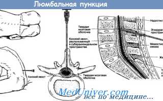 Люмбальная пункция норма. Спинномозговая пункция: показания, противопоказания, техника проведения. Показания к назначению