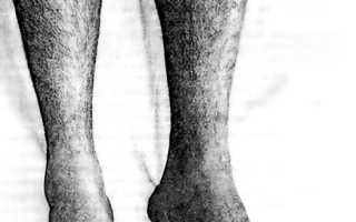 Почему худеет одна нога причины. Одна нога короче другой у ребенка. Миотония, сцепленная с полом, протекающая с атрофией мышц ног