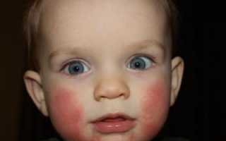 Шершавые щеки у ребенка 1 год. Причины покраснения щек у взрослых и детей — как избавиться лекарственными и народными средствами. Возможные аллергены для грудничка