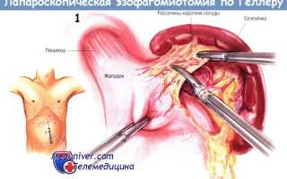 Результаты эндохирургического лечения ахалазии кардии. Способ хирургического лечения ахалазии пищевода Операция геллера с какого года проводится