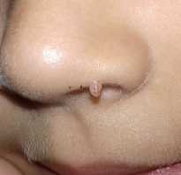 Как удалить папиллому из носа. Симптомы и лечение папилломы на носу у ребенка