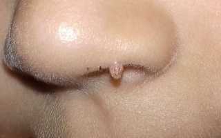 Как удалить папиллому из носа. Симптомы и лечение папилломы на носу у ребенка