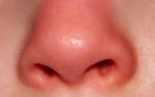 Покраснение носа: причины, симптомы и связь с болезнями, как избавиться и лечить. Нос красный: причины, лечение народными средствами Как избавиться от покраснения на носу