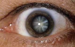 Как действовать при травматической катаракте. Контузия хрусталика и посттравматическая катаракта: признаки, диагностика, лечение Поврежден хрусталик глазной чем лечить