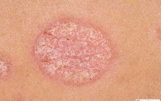 Псориаз признаки заболевания. Псориаз кожи: отличительные признаки и особенности лечения болезни в домашних условиях (110 фото и видео)