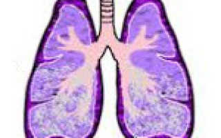 Отек легких в международной классификации болезней. Отёк лёгких – описание, диагностика, лечение Симптомы отека легких