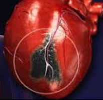 Характерные признаки и последствия инфаркта передней стенки сердца. Инфаркт миокарда. Виды, причины и лечение инфаркта миокарда. Кардиогенный шок Боковой инфаркт миокарда на экг признаки