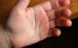 К чему и почему чешутся ладони рук у ребенка, женщин, мужчин. Почему чешутся ладони рук – основные причины Чешутся ладошки у ребенка чем лечитьОтеки][