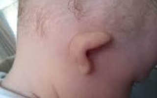 Недоразвитие внутреннего уха. Заболевания и аномалия развития внутреннего уха. Врожденная аномалия внутреннего уха. Причины аномалий развития ушной раковины