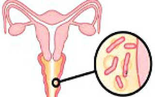 Бактериальный вагиноз причины появления. Вагиноз: причины, симптомы, диагностика, лечение. Причины бактериального вагиноза
