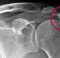 Болезни мышц плечевого сустава — Лечение Суставов. Сколиозы