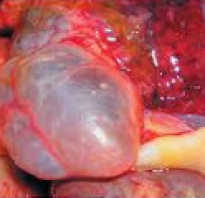 Буллезная эмфизема легкого. Эмфизема легких – клиника, диагностика, лечение Буллезная эмфизема мкб 10