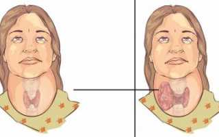 Мкб 10 щитовидной железы код. Опухоли щитовидной железы – описание, симптомы (признаки), диагностика, лечение