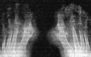 Рентгенологический метод в диагностике заболеваний суставов. Подагрический артрит и клиника рентгенологических проявлений симптома пробойника Подробнее о лечении подагры