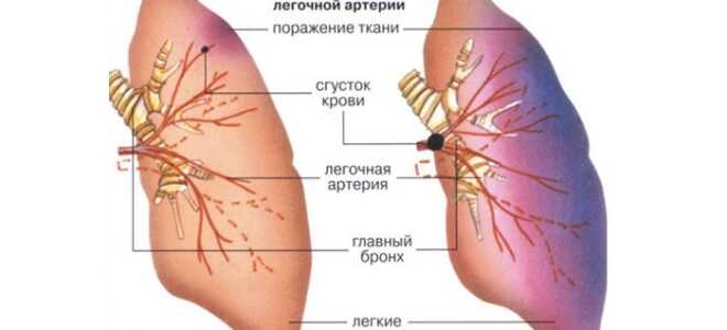 Что такое тэла и как спасают жизни при тромбоэмболии легочной артерии? Тромбоэмболия легочной артерии: как защититься от внезапного «удара»? Тромбоэмболия мелких ветвей легочной артерии мкб 10.