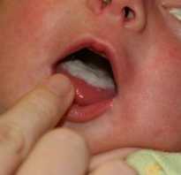 Молочница рта у детей лечение. Оральный кандидоз или молочница во рту у грудничка: лечение при помощи безопасных медикаментов и народных средств